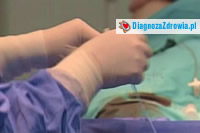 Angioplastyka wieńcowa