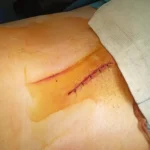 Przepuklina pachwinowa – objawy, leczenie…